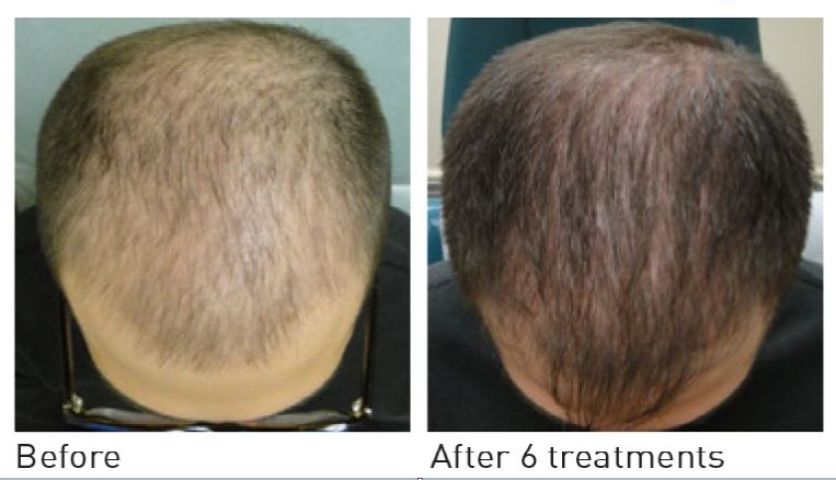 PRP Hair Restoration - Rejuva Medispa & Laser